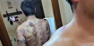 Cum arată spatele lui Alin Firfirică, atlet calificat la JO - după terapia cu ventuze și laser!